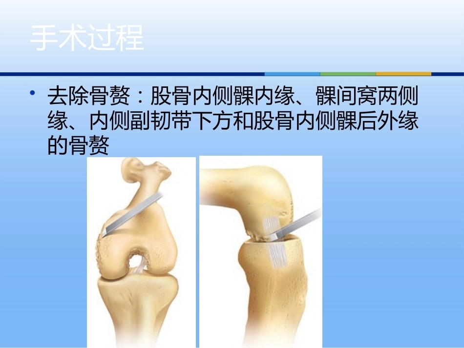 膝关节单髁 置换二_第14页