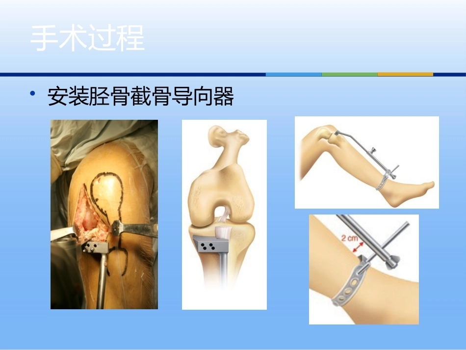 膝关节单髁 置换二_第15页