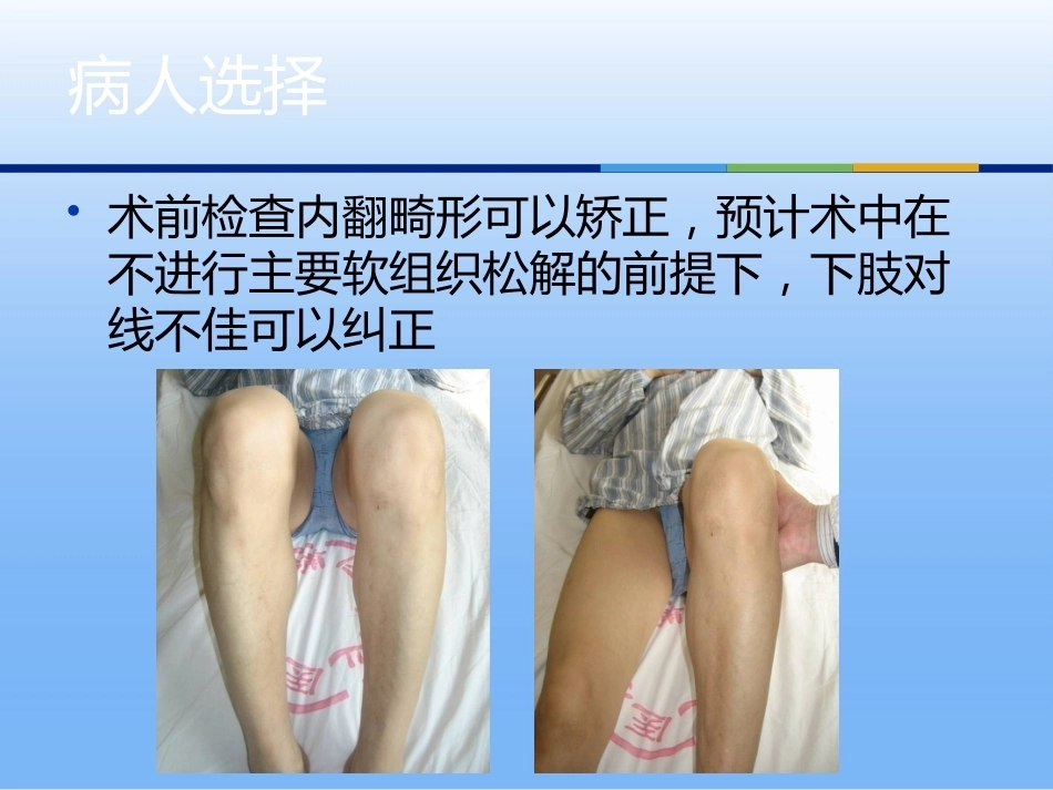 膝关节单髁 置换二_第5页