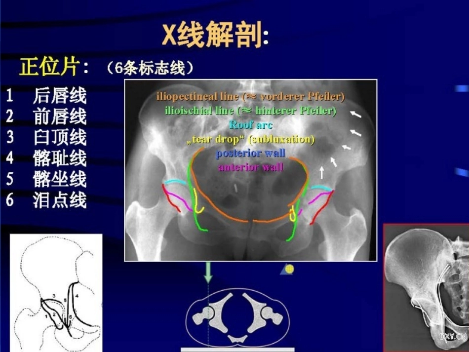 Stoppa及其改良入路的简介及临床应用_第11页