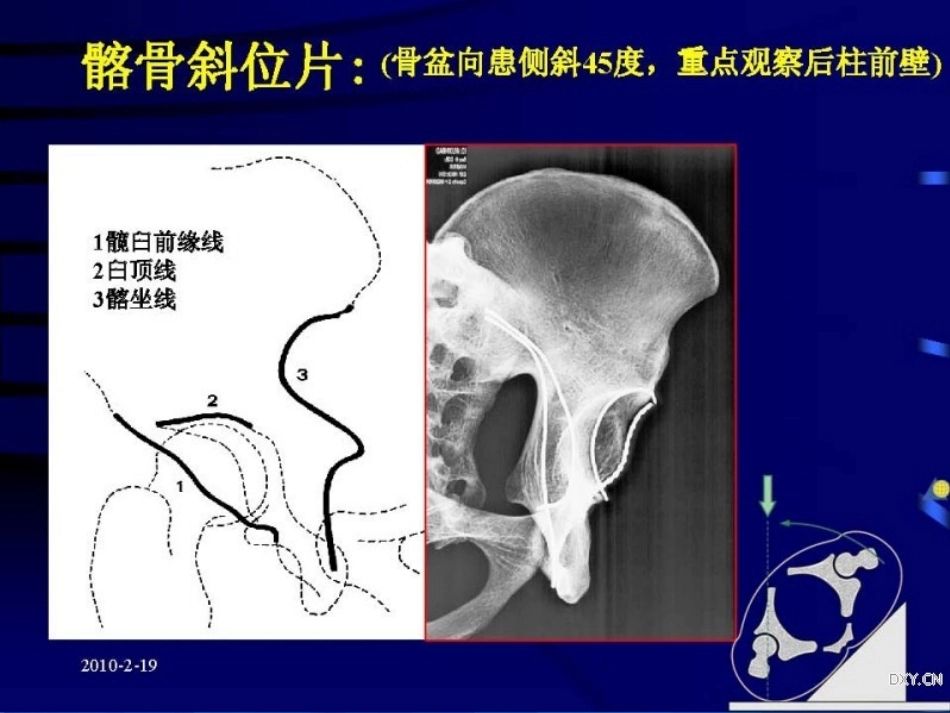 Stoppa及其改良入路的简介及临床应用_第12页