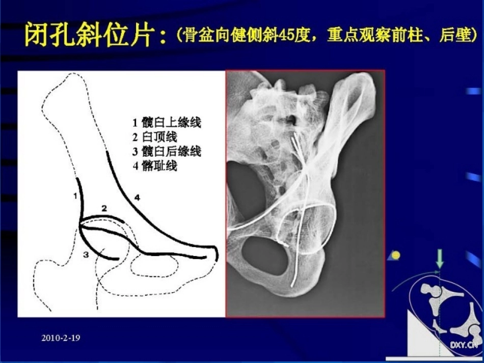 Stoppa及其改良入路的简介及临床应用_第13页