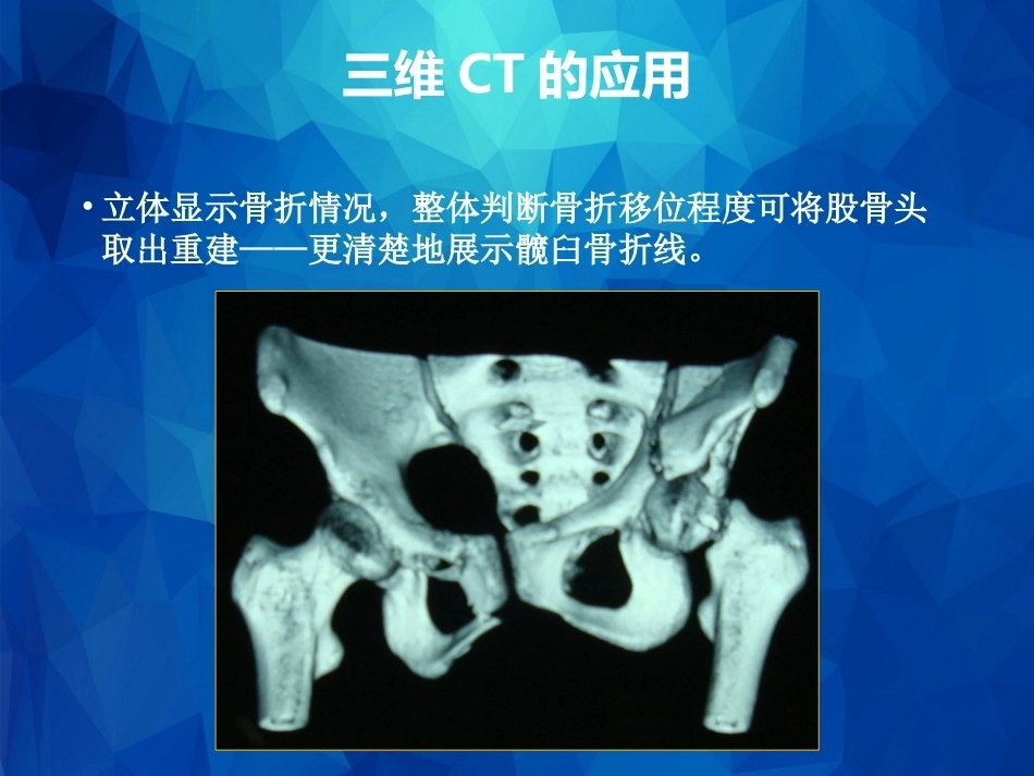 Stoppa及其改良入路的简介及临床应用_第15页