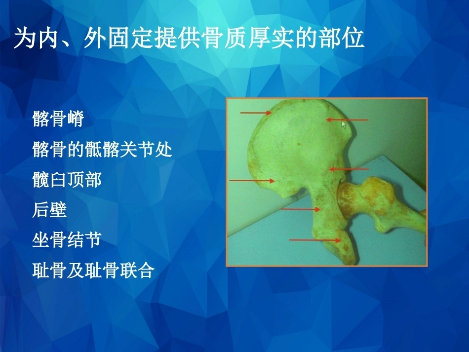 Stoppa及其改良入路的简介及临床应用_第4页