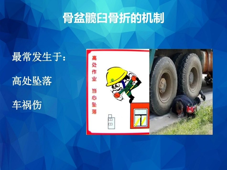 Stoppa及其改良入路的简介及临床应用_第6页