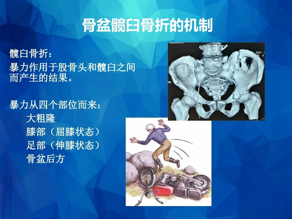 Stoppa及其改良入路的简介及临床应用_第8页