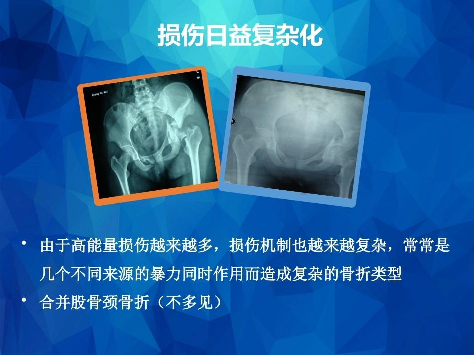 Stoppa及其改良入路的简介及临床应用_第9页