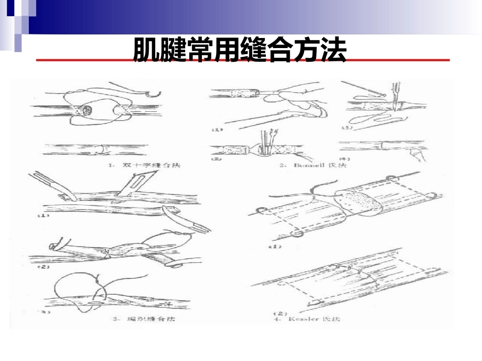 急性跟腱中部断裂的诊 治_第11页