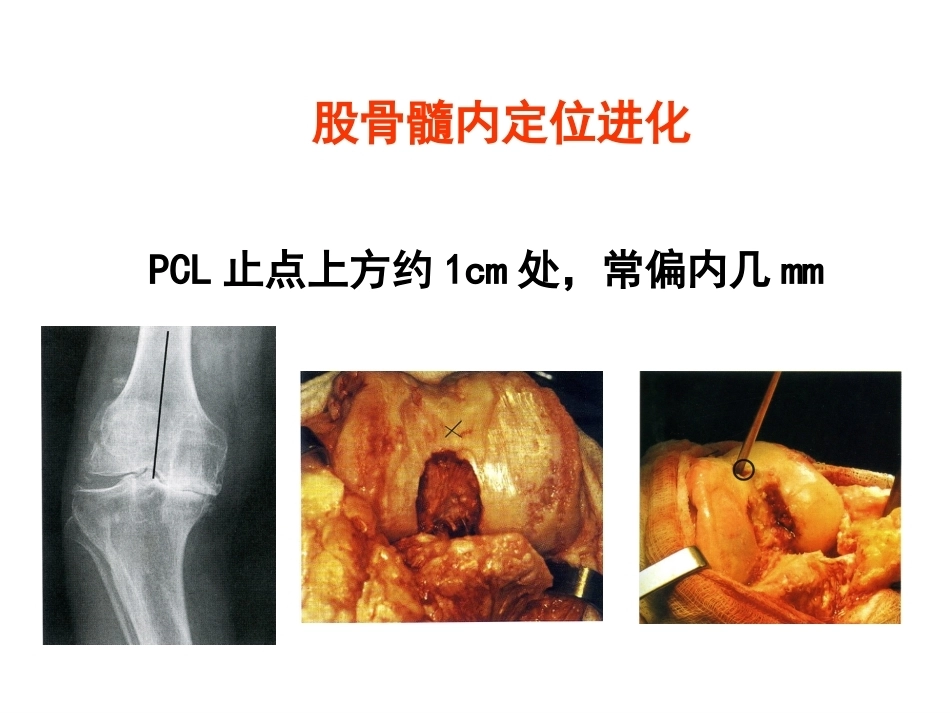 全膝关节置换的 手术原则_第15页