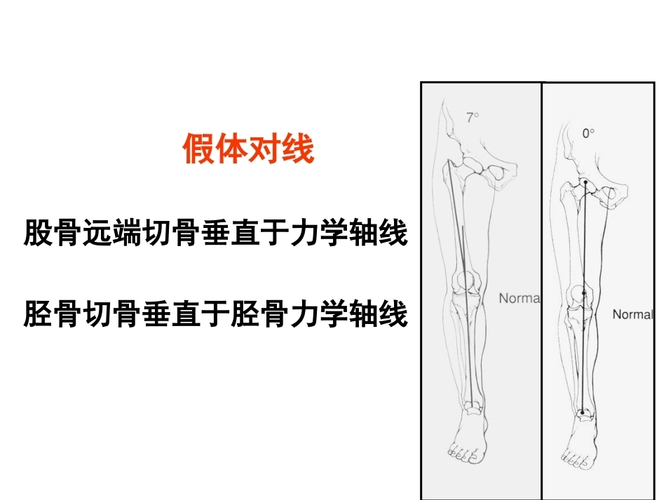 全膝关节置换的 手术原则_第7页