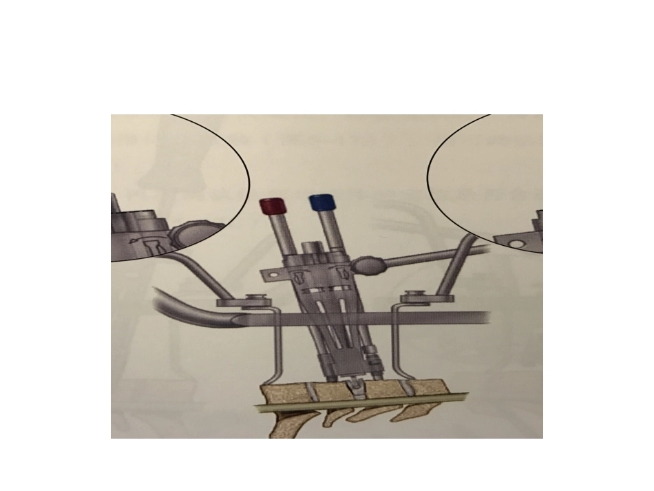 颈椎人工椎间 盘CDR_第11页