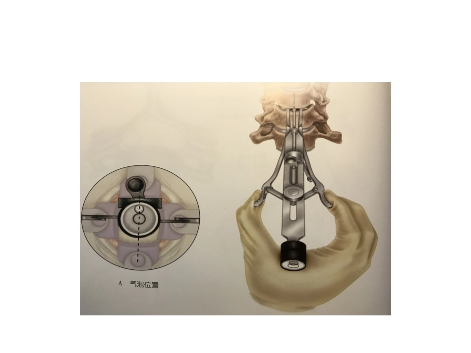 颈椎人工椎间 盘CDR_第14页