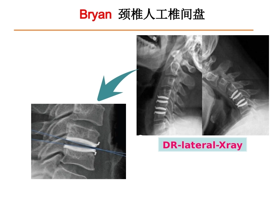 颈椎人工椎间 盘CDR_第7页