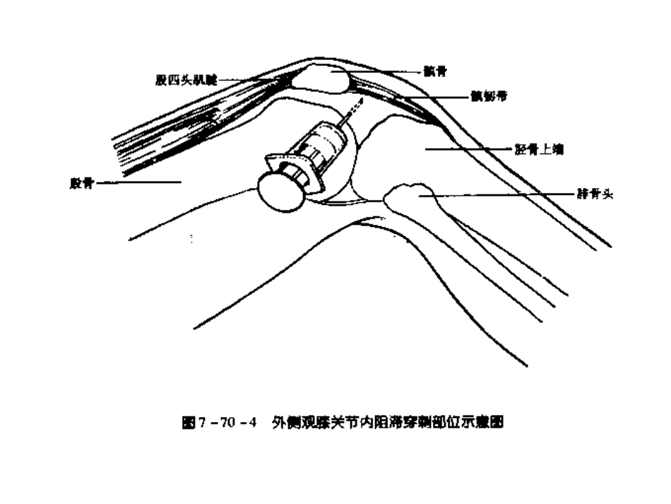 十二关节腔内穿刺注射_第14页