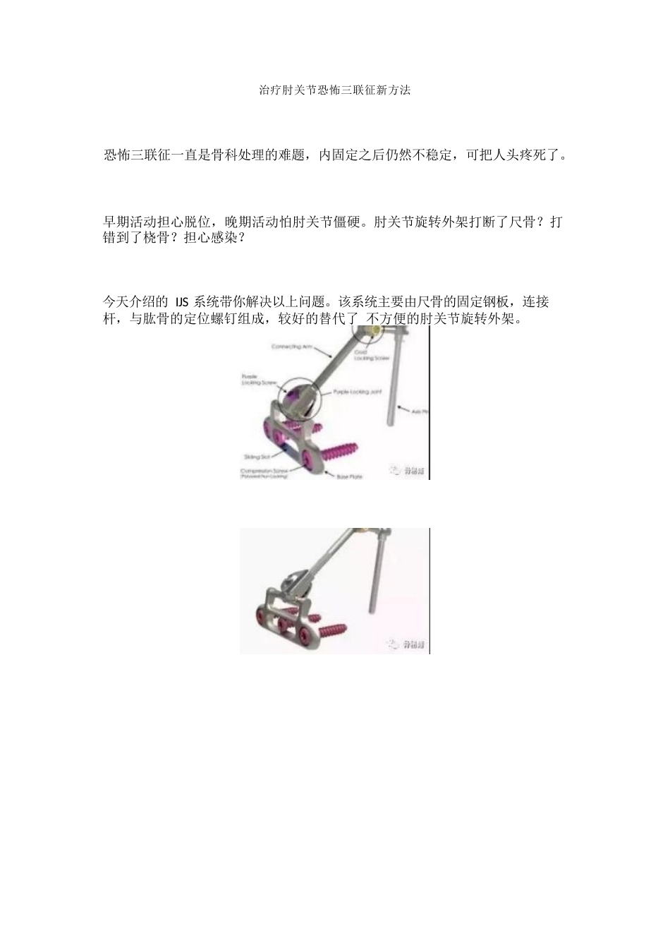 治疗肘关节恐怖三联征 新方法_第1页