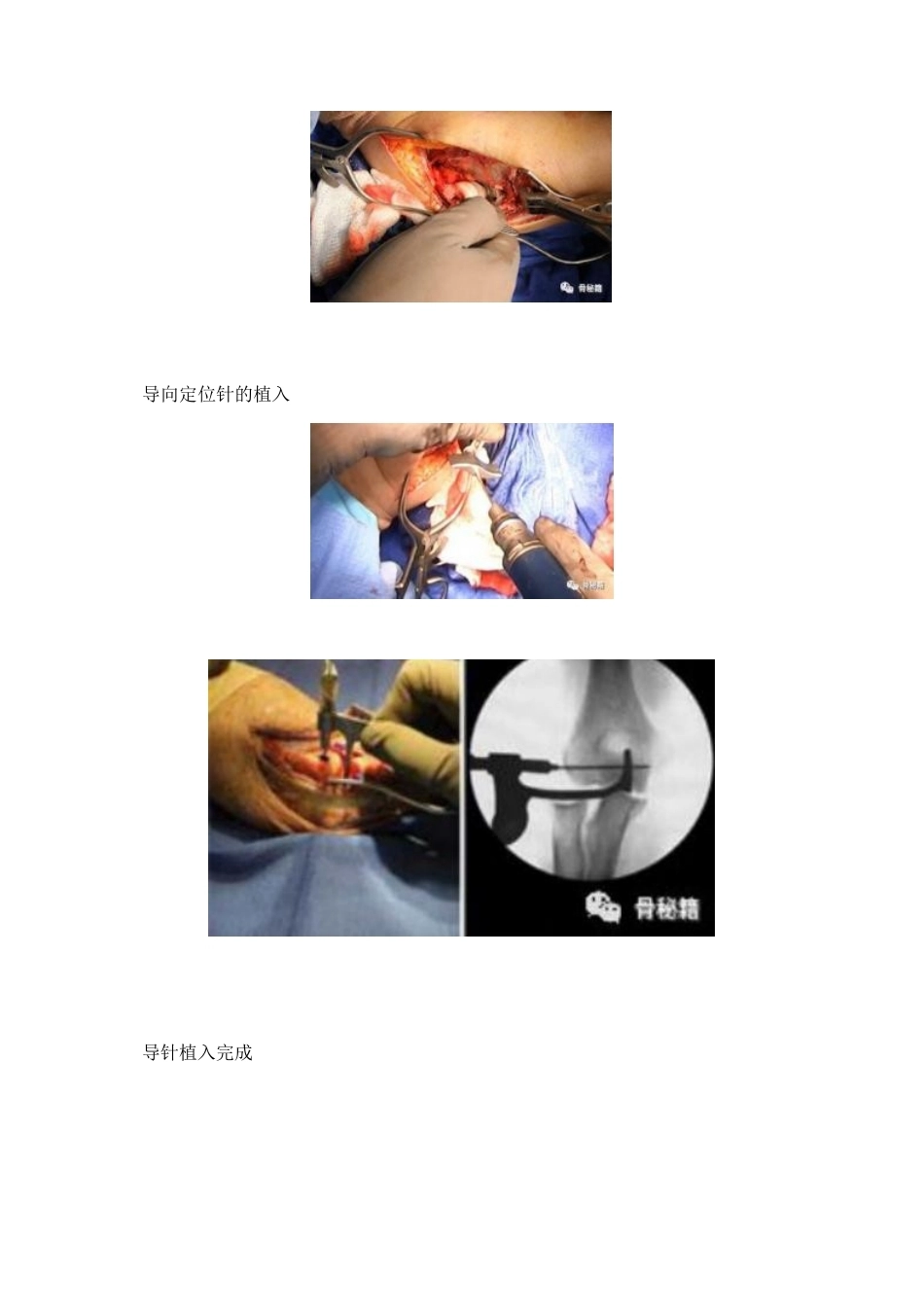 治疗肘关节恐怖三联征 新方法_第4页