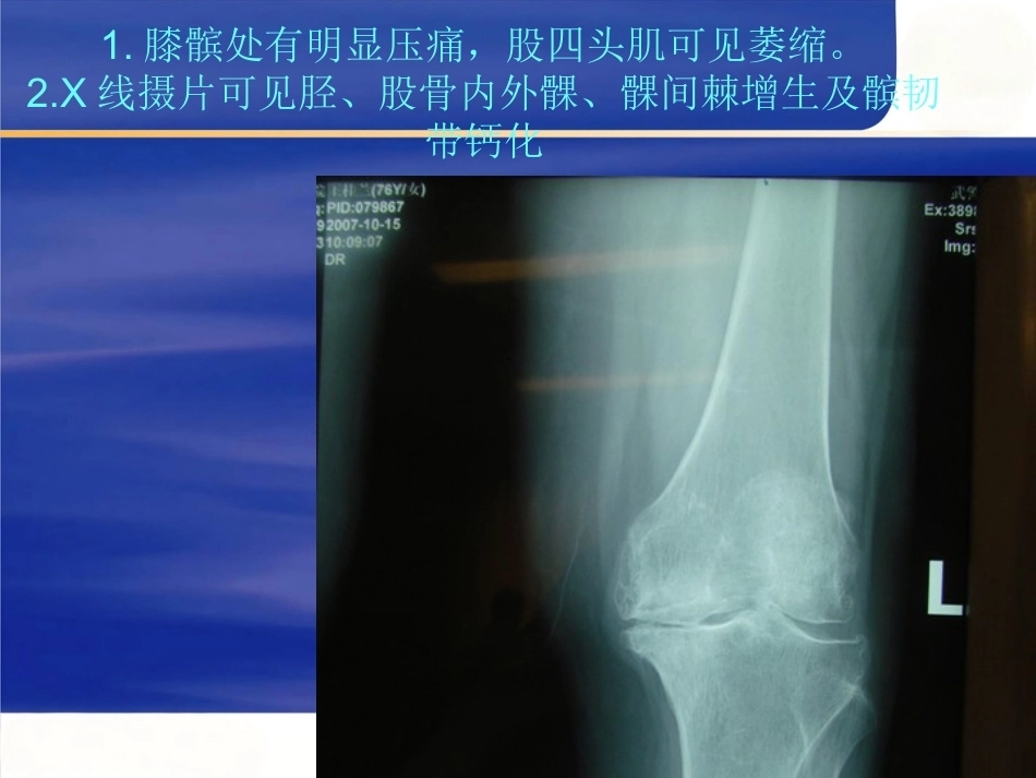 膝关节骨性关节 炎的中西医治疗_第11页