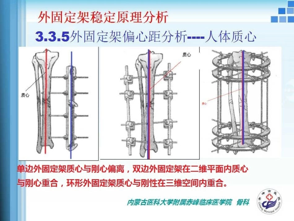 外固定支架的力学 原理_第14页