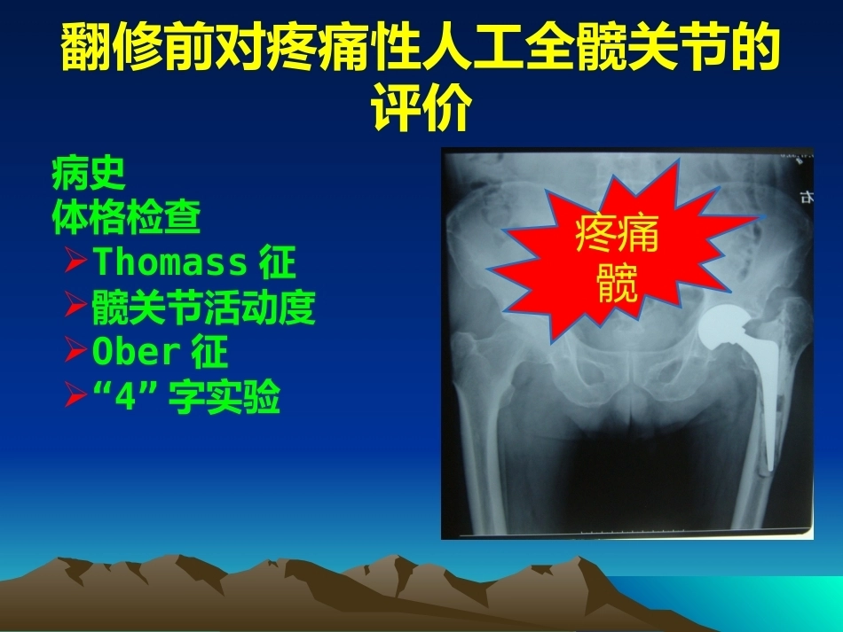 人工全髋关节翻修的思考和 处理策略_第11页