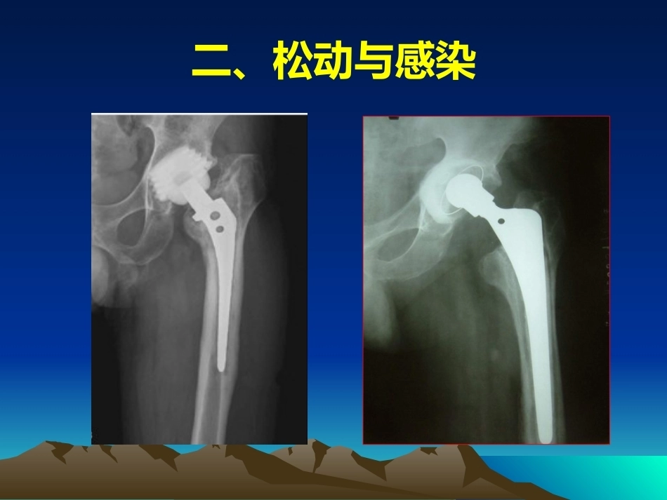 人工全髋关节翻修的思考和 处理策略_第13页