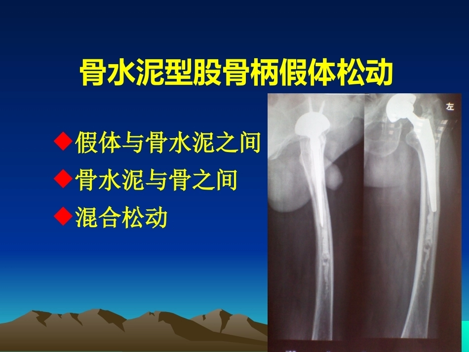 人工全髋关节翻修的思考和 处理策略_第15页
