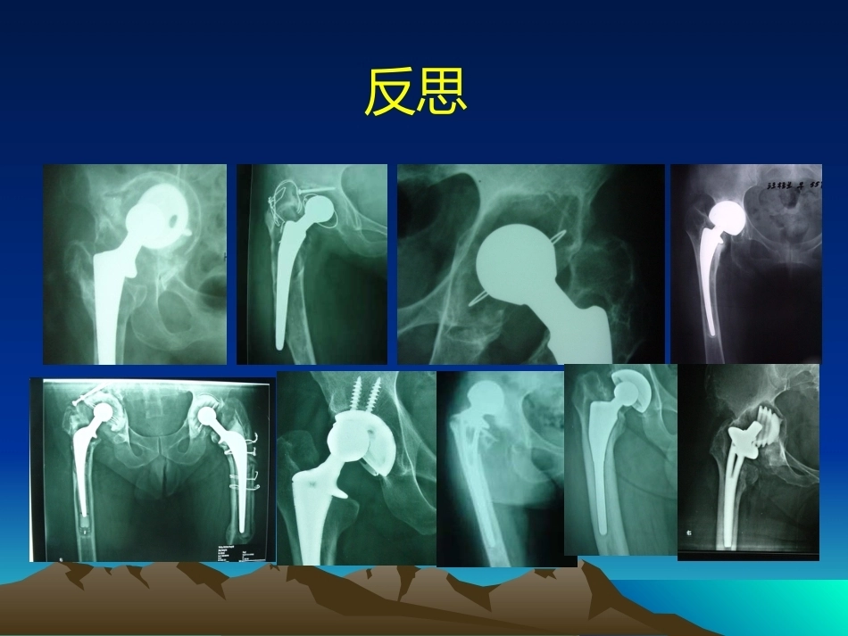 人工全髋关节翻修的思考和 处理策略_第4页