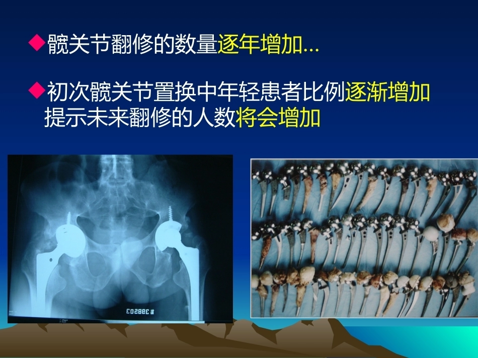 人工全髋关节翻修的思考和 处理策略_第5页