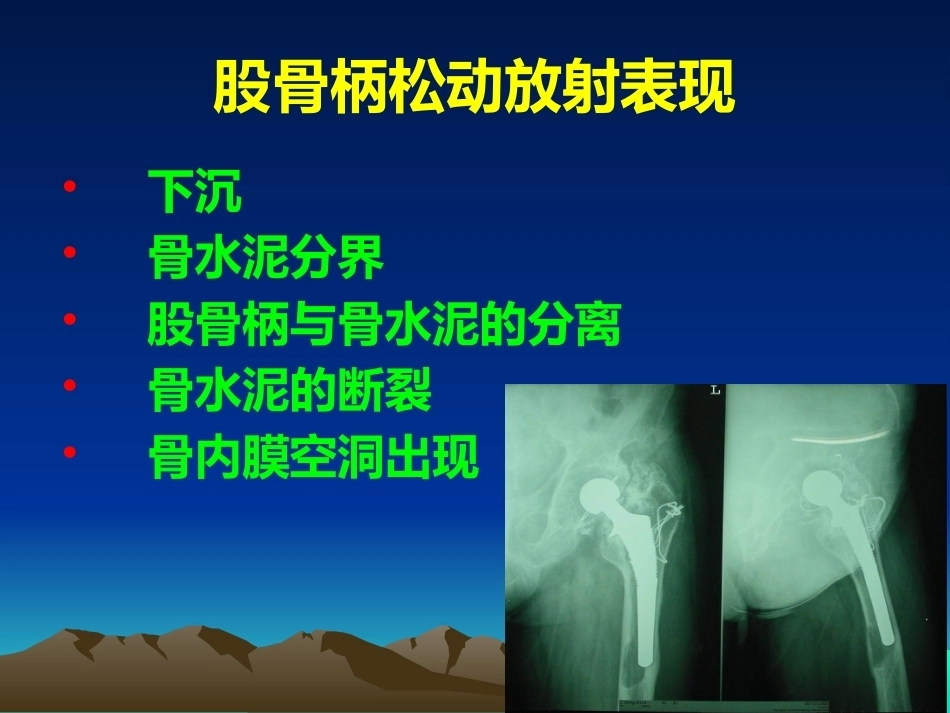 人工全髋关节翻修的思考和 处理策略_第9页