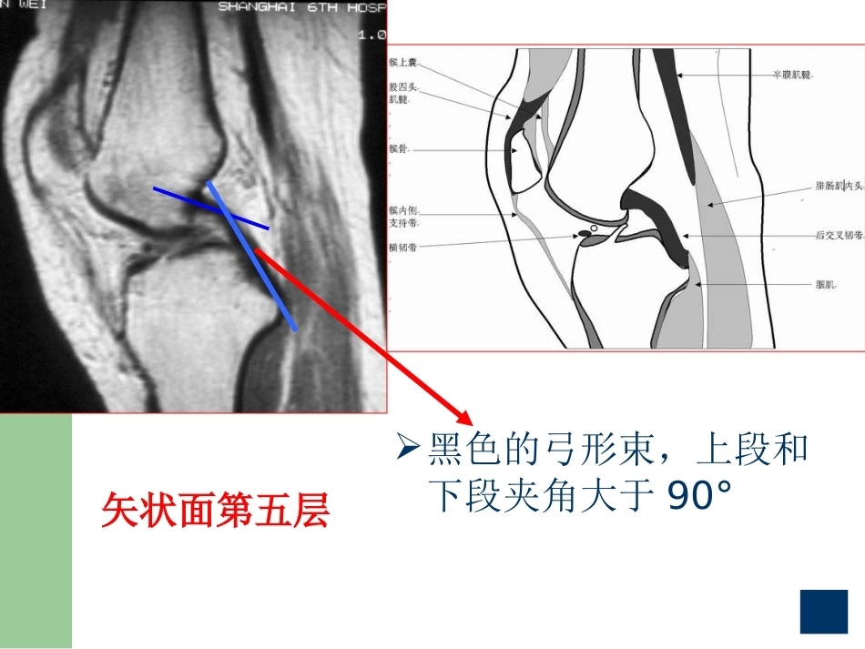 膝关节半月板损伤 MRI诊断(ppt)_第12页