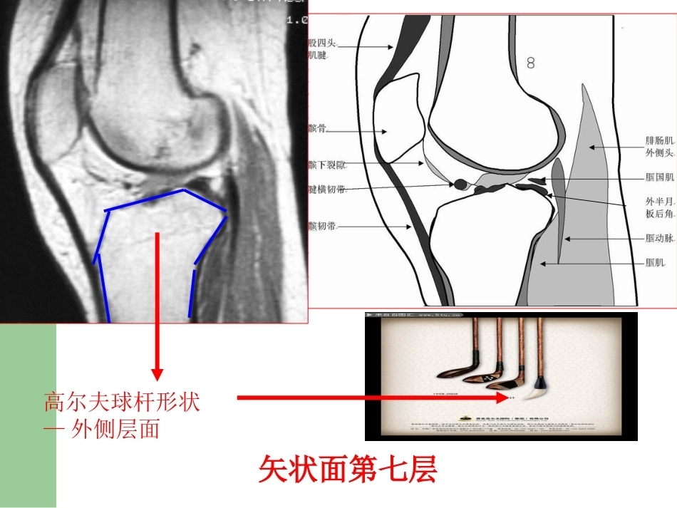 膝关节半月板损伤 MRI诊断(ppt)_第14页