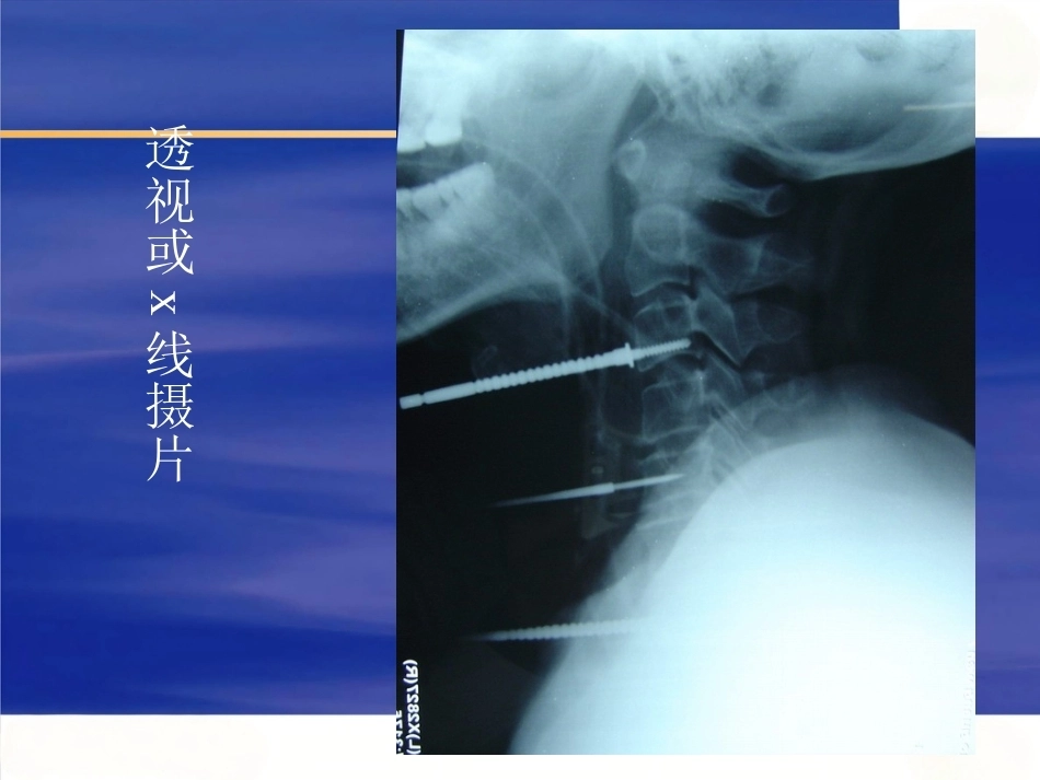 颈椎前路手 术操作技术_第11页