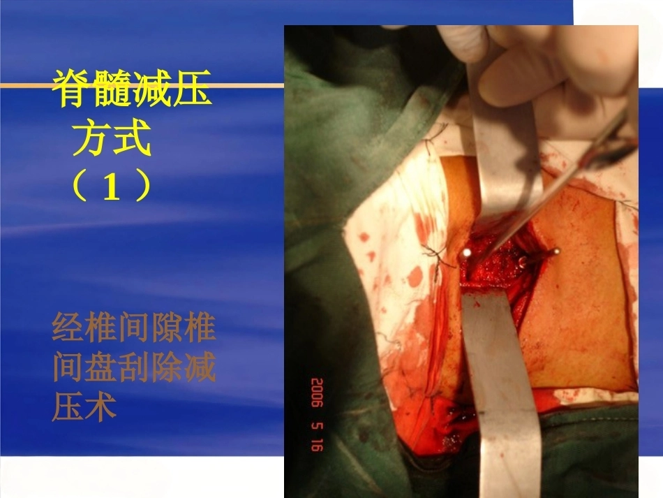 颈椎前路手 术操作技术_第12页
