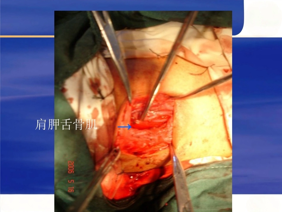 颈椎前路手 术操作技术_第8页