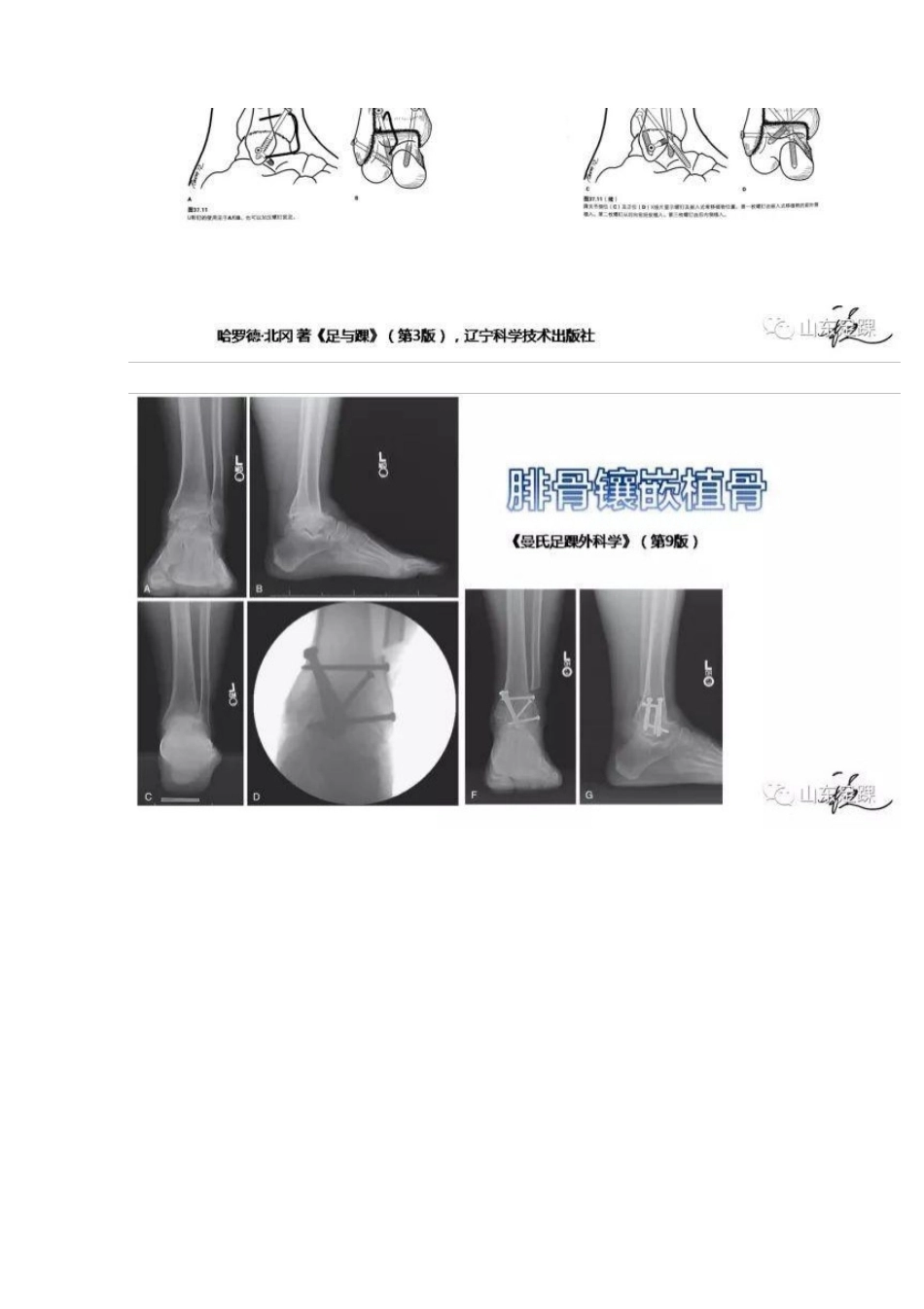 踝关节融合术的基本 手术策略与技巧_第10页