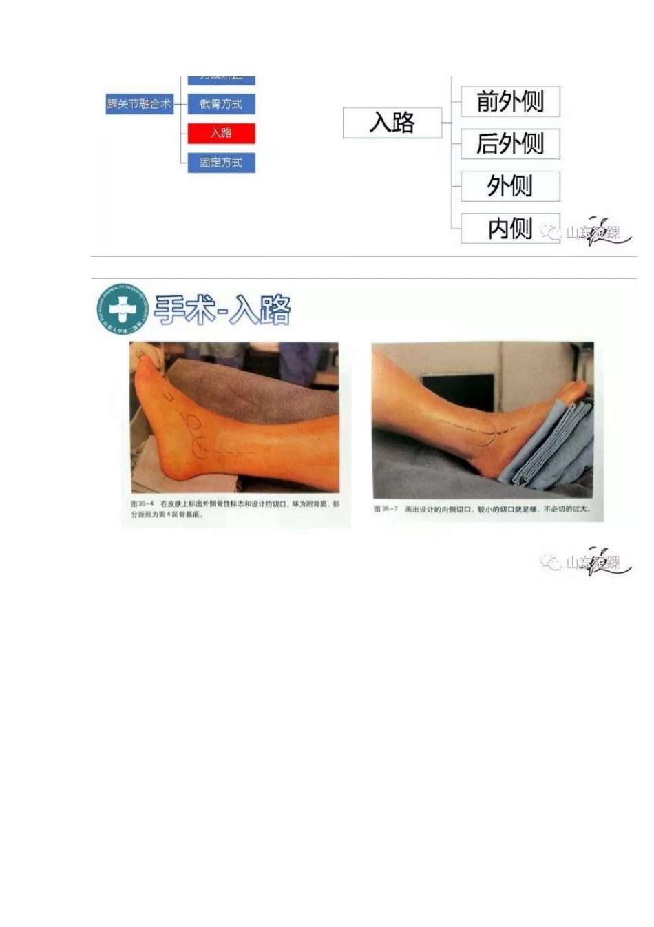 踝关节融合术的基本 手术策略与技巧_第12页