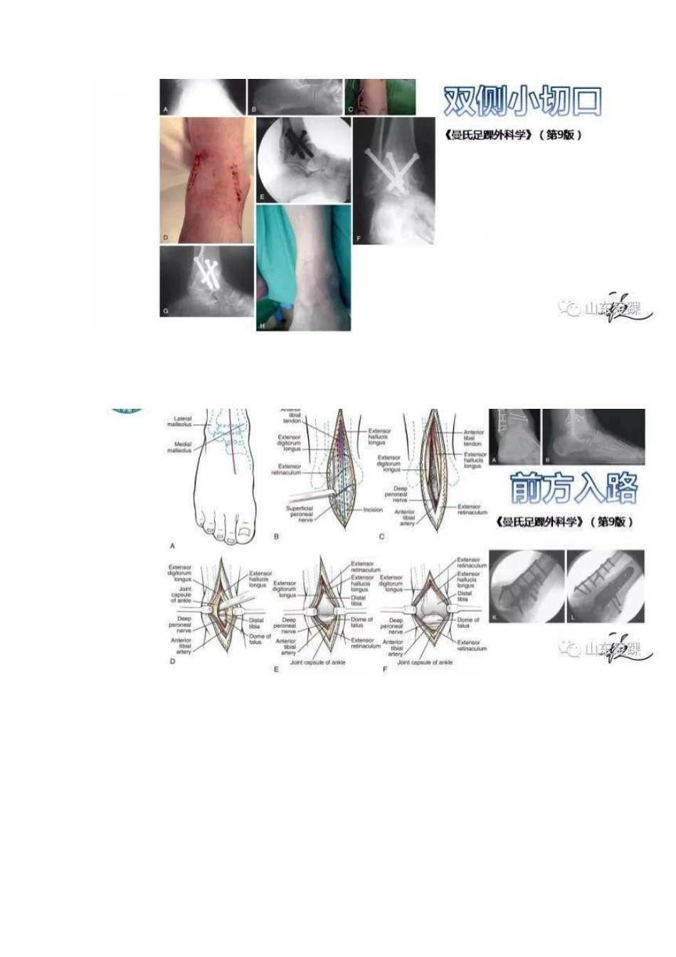踝关节融合术的基本 手术策略与技巧_第14页