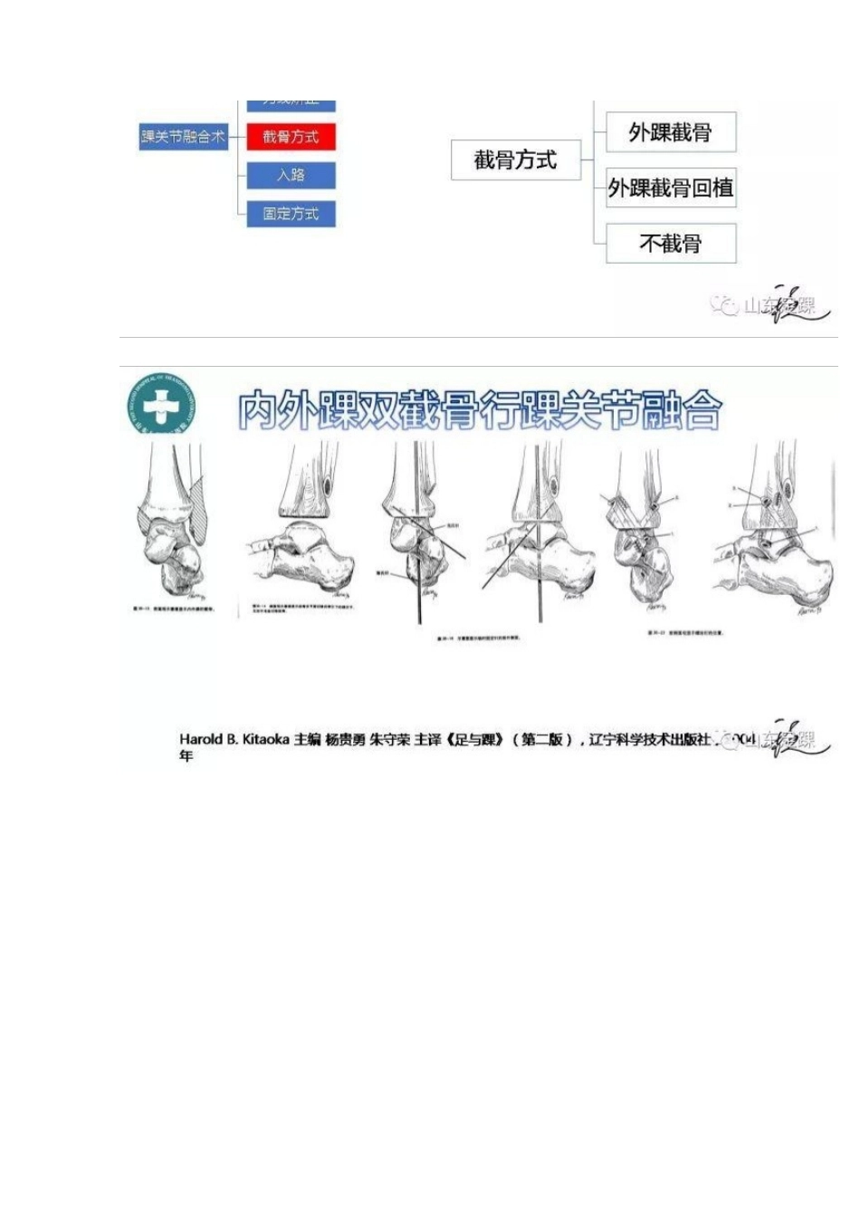 踝关节融合术的基本 手术策略与技巧_第8页