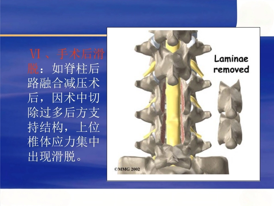 腰椎滑 脱症_第11页