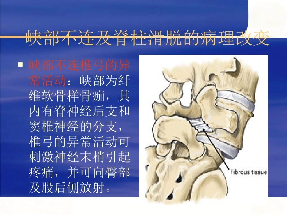 腰椎滑 脱症_第12页