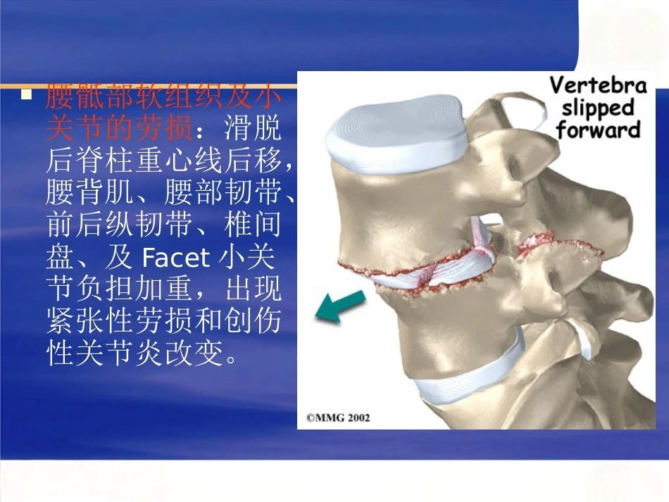 腰椎滑 脱症_第13页