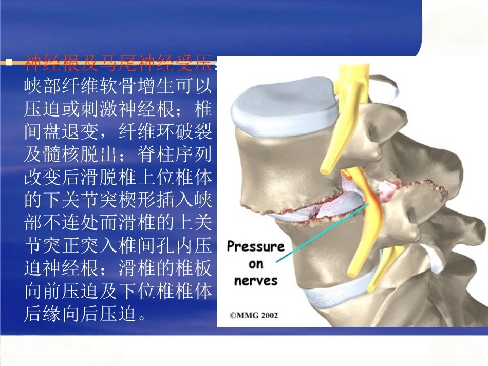 腰椎滑 脱症_第14页