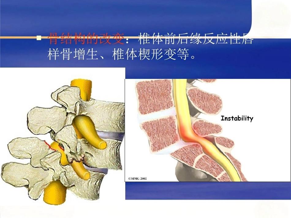 腰椎滑 脱症_第15页