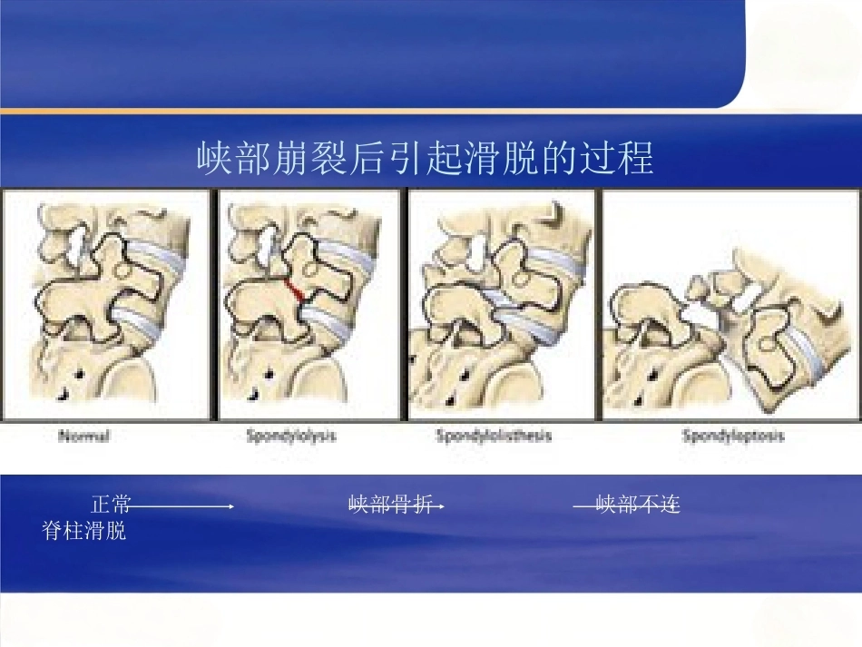 腰椎滑 脱症_第6页