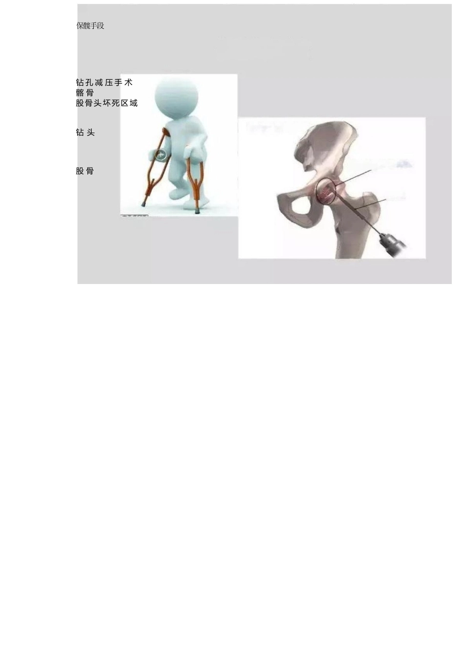 冲击波疗法治疗 股骨头坏死_第10页