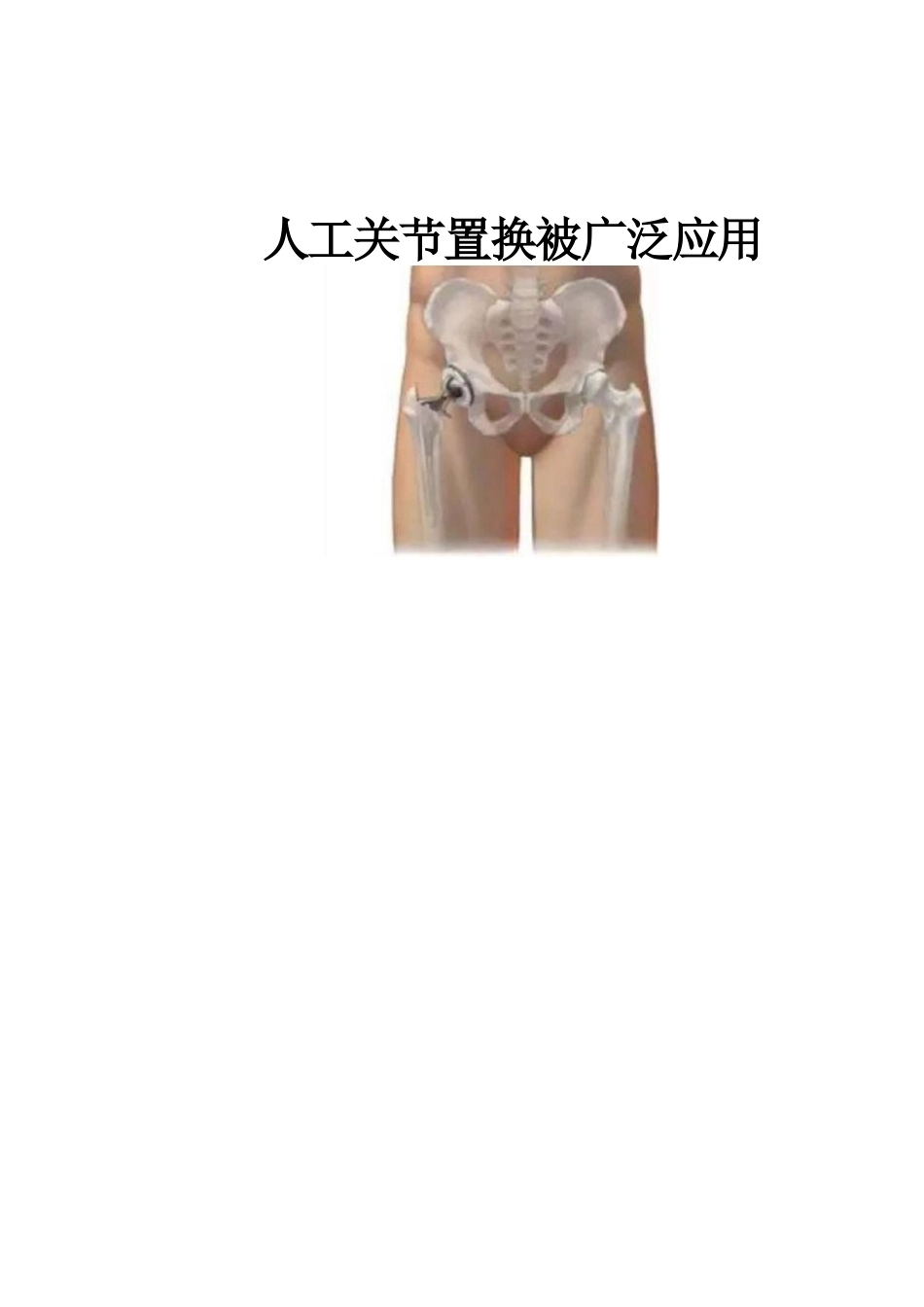冲击波疗法治疗 股骨头坏死_第11页
