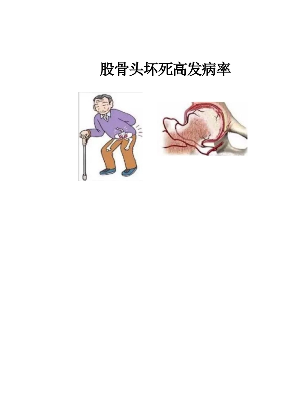 冲击波疗法治疗 股骨头坏死_第2页