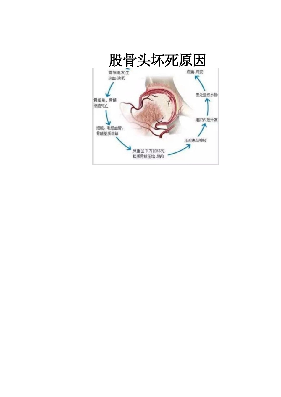 冲击波疗法治疗 股骨头坏死_第4页