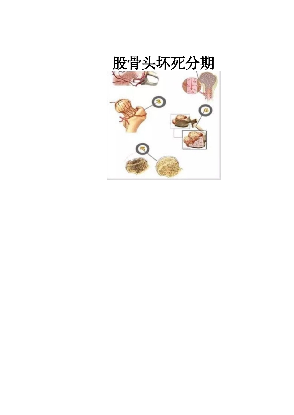 冲击波疗法治疗 股骨头坏死_第8页