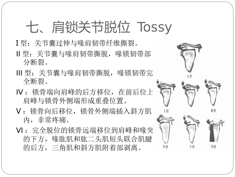 骨与关节骨折分型_第12页