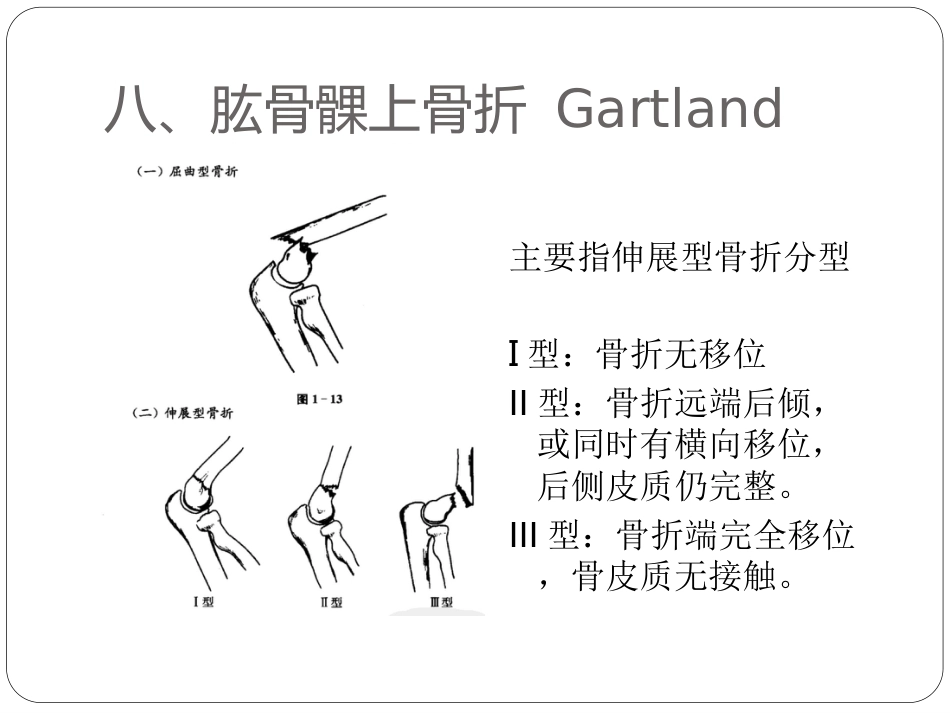 骨与关节骨折分型_第13页